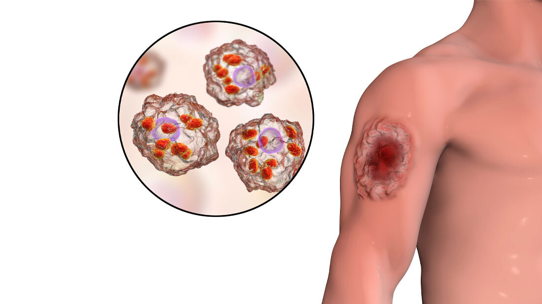 Symbolbild für kutane Leishmaniose.