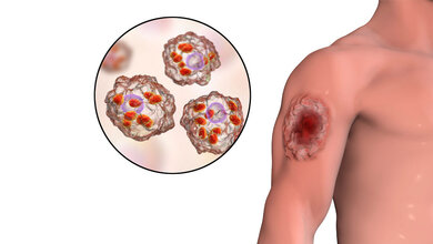 Symbolbild für kutane Leishmaniose.