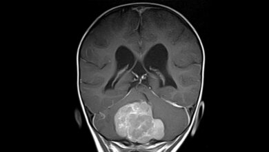 MRT Bild Medulloblastom