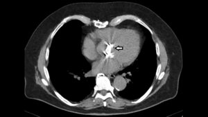 CT des Thorax mit Metallartefakt