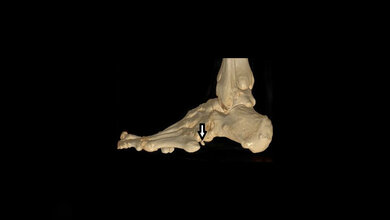 Anomalies and Norm Variants – Skeletal Changes 3.22