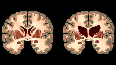 Abbildung eines normalen Gehirns und eines Gehirns bei Morbus Huntington