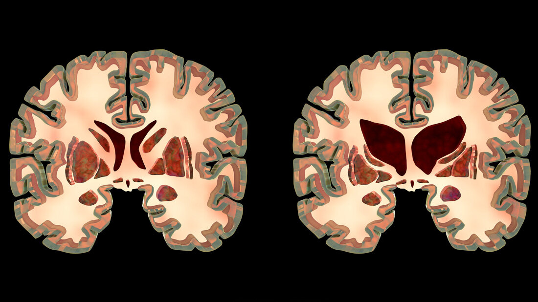 Abbildung eines normalen Gehirns und eines Gehirns bei Morbus Huntington