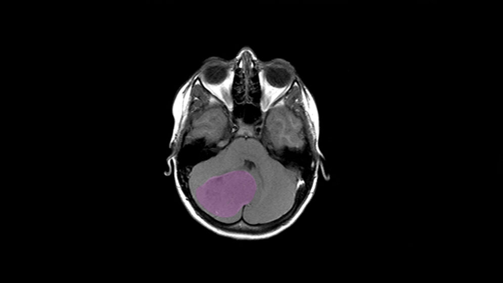 MRT-Darstellung eines Medulloblastoms 
