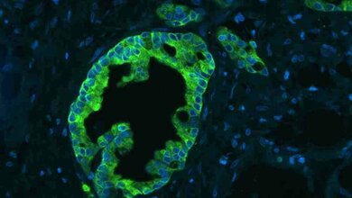 MenschlicheBauchspeicheldrusenkrebszellen_Martin_Sprick_DKFZ_03032016.jpg Menschliche Bauchspeicheldrüsenkrebszellen