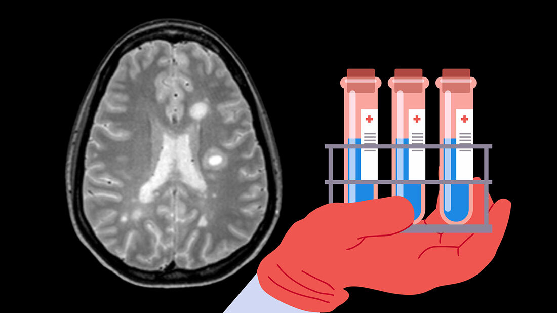 Hirnscan auf schwarzem Hintergrund mit der Grafik einer Hand, die Reagenzgläser in der Hand hält