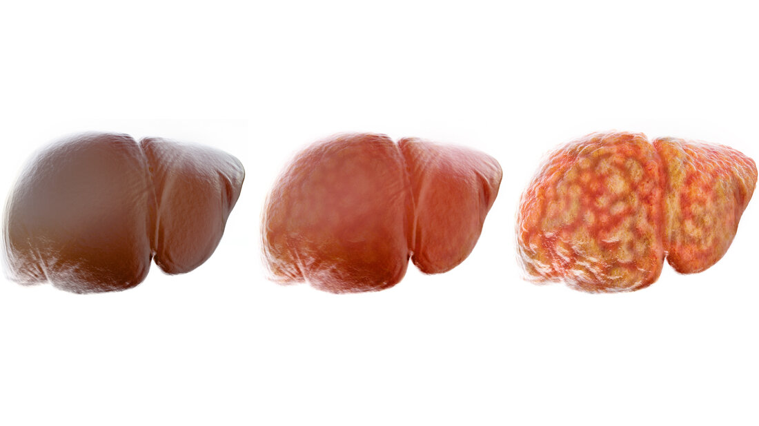 Stufen_der_Fettleber_crevis_stock_adobe_com.jpg Stufen der Fettleber