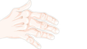 Rheumatoide Arthritis