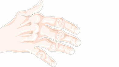 Rheumatoide Arthritis