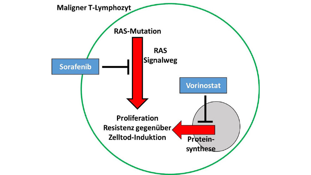 Schematische_Darstellung_eines_malignen_T_Lymphozyten_des_Sezary_Syndroms_PD_Dr_Karsten_Guelow.jpg Schematische_Darstellung_eines_malignen_T_Lymphozyten_des_Sezary_Syndroms_PD_Dr_Karsten_Guelow.jpg