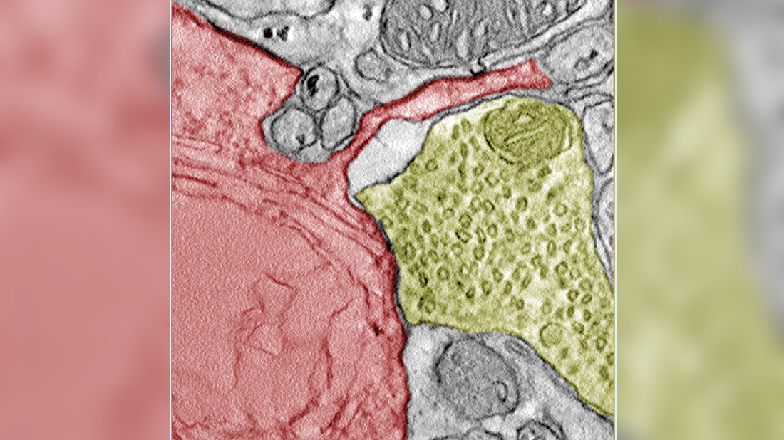 Elektronenmikroskopische Aufnahme eines SCLC-Allotransplantats aus einem Mäusegehirn, die einen synaptischen Kontakt zwischen einer Krebszelle (rot) und einem neuronalen Terminal (gelb) zeigt.