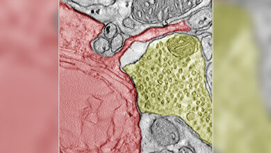 Elektronenmikroskopische Aufnahme eines SCLC-Allotransplantats aus einem Mäusegehirn, die einen synaptischen Kontakt zwischen einer Krebszelle (rot) und einem neuronalen Terminal (gelb) zeigt.
