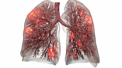 Zustand der Patientenlunge