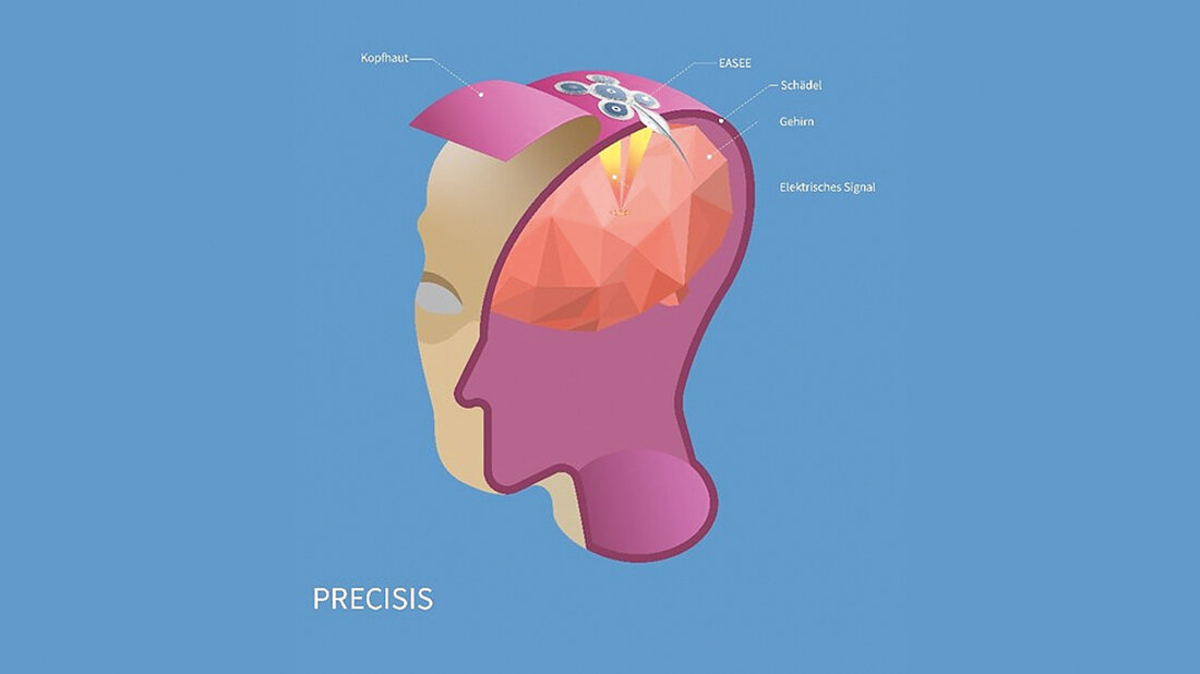 Produktabbildung Gehirn-Schrittmacher EASEE (Epicranial Application of Stimulation Electrodes for Epilepsy)