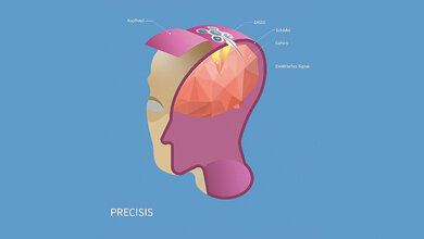 Produktabbildung Gehirn-Schrittmacher EASEE (Epicranial Application of Stimulation Electrodes for Epilepsy)