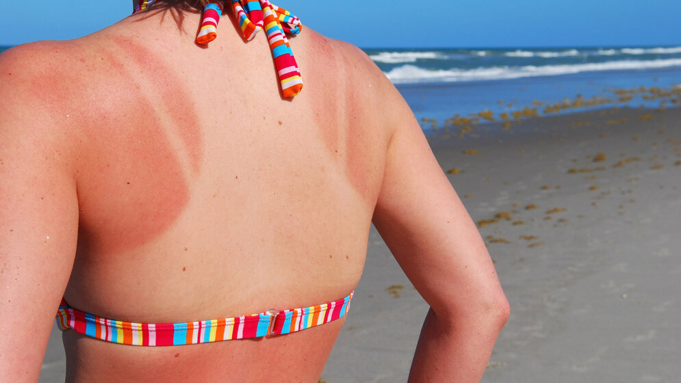 Sonnenbrand