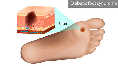 Diabetischer_Fuss_Pandemie.jpg