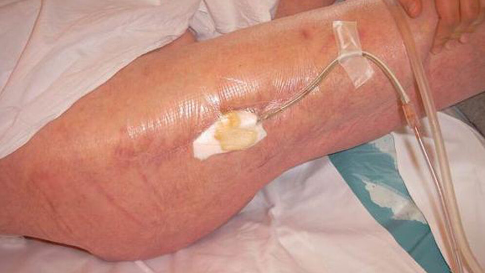 Eiteraustritt aus einer Fistel 