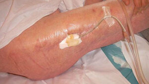 Eiteraustritt aus einer Fistel 