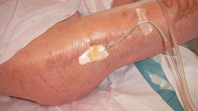 Eiteraustritt aus einer Fistel 