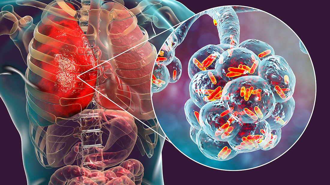 Hoffnung auf RNA-Medikament gegen Lungenentzündung