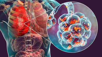 Hoffnung auf RNA-Medikament gegen Lungenentzündung