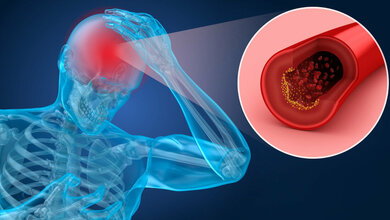 Blutgruppe: Einfluss auf Schlaganfallrisiko?