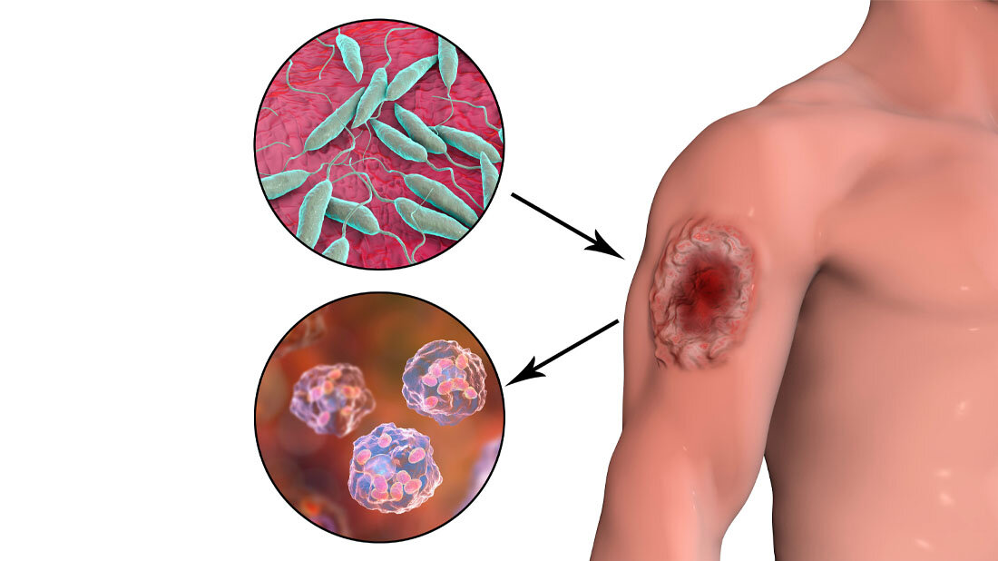 leishmaniose.jpg Leishmaniose