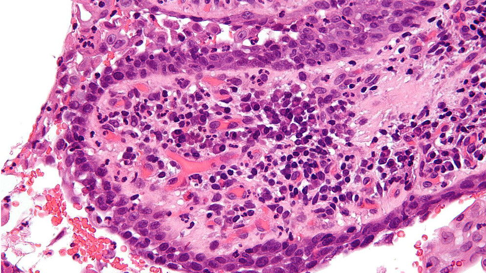 Pemphigus vulgaris