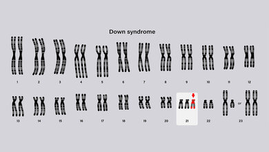 Überblick der Gene bei Down-Syndrom