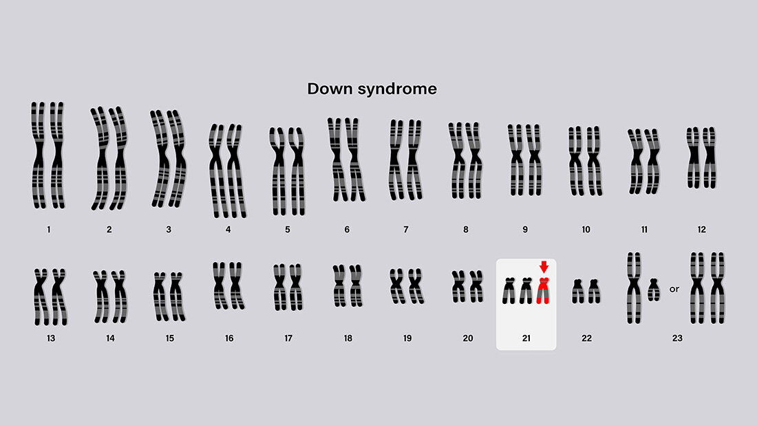 DownSyndrom_AdobeStock_470792912.jpg Überblick der Gene bei Down-Syndrom