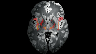 Hirnscan_Tics.jpg Neuronales Netzwerk, das Tics auslösen kann