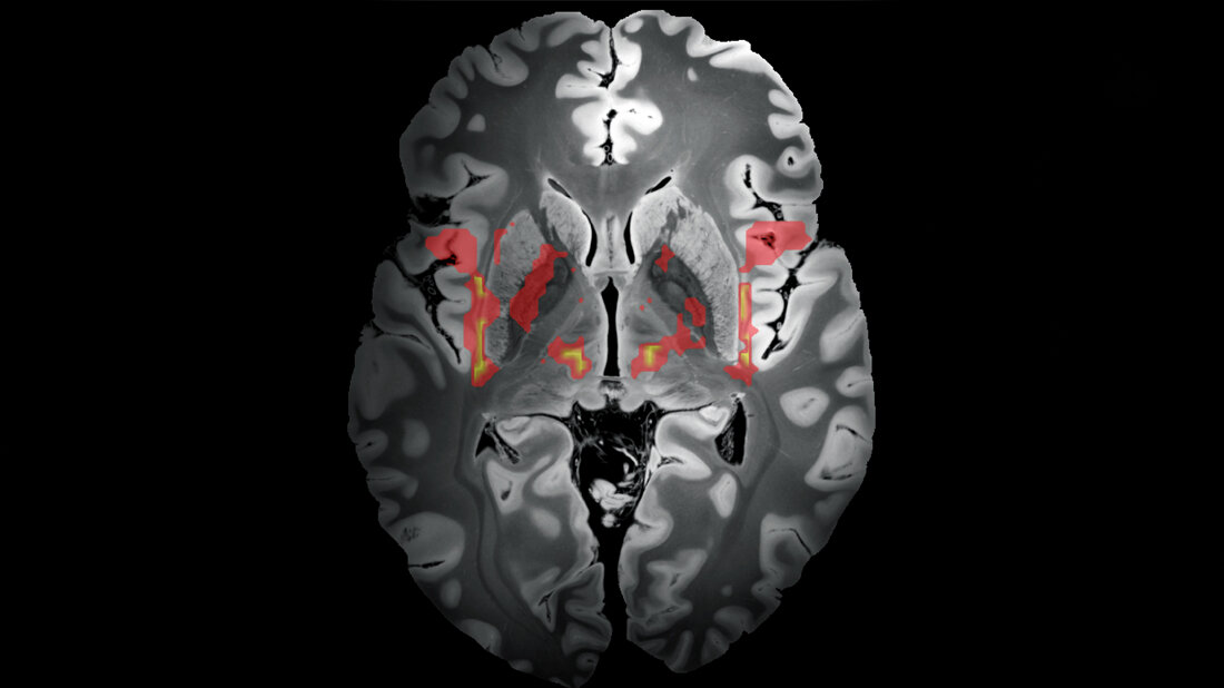 Neuronales Netzwerk, das Tics auslösen kann