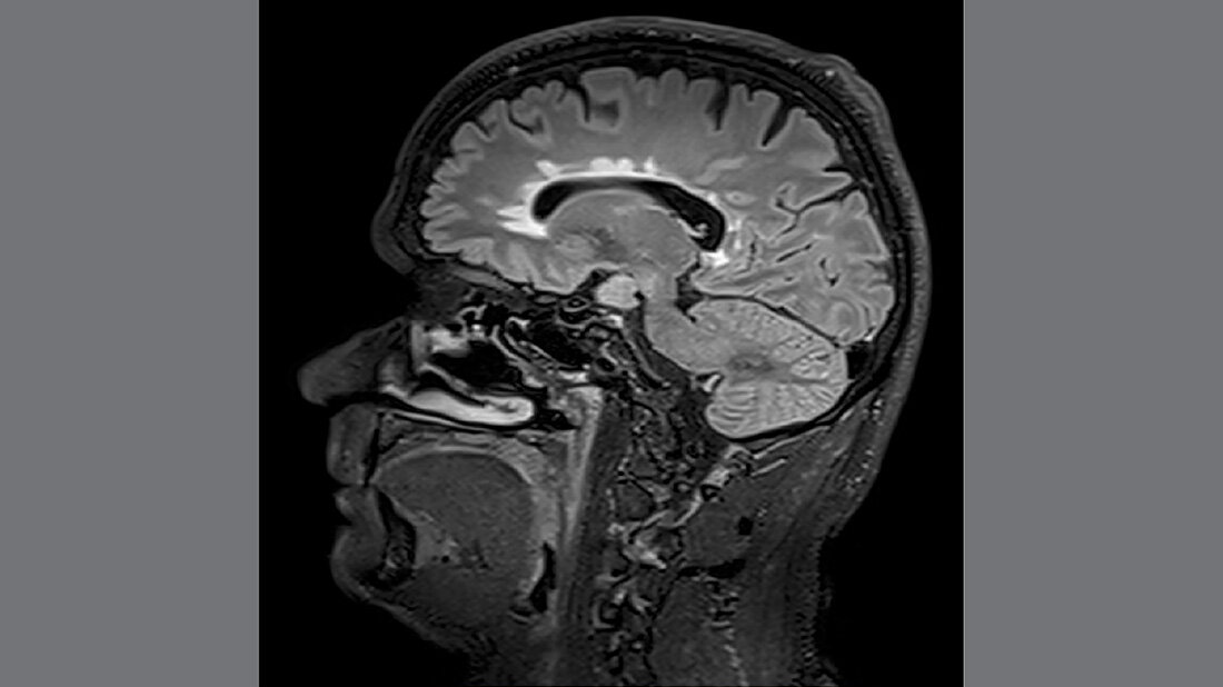 MRT Multiple Sklerose