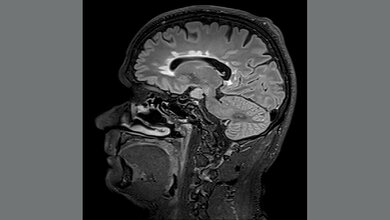 MRT Multiple Sklerose
