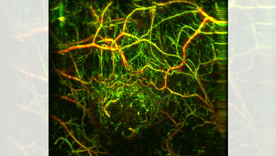 frühere Diagnose von Tumorerkrankungen
