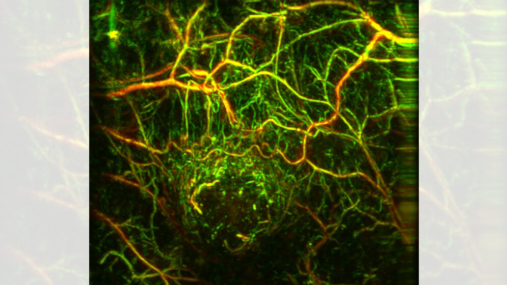 frühere Diagnose von Tumorerkrankungen