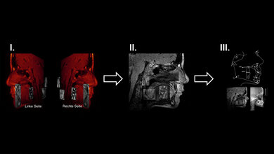 Prinzip der MRT-basierten Vermessung von Schädelstrukturen