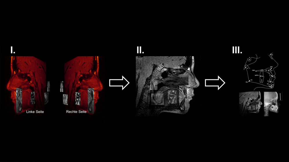 Prinzip_der_MRT_basierten_Vermessung_modifiziert_nach_Heil_et_al_PLoS_One_2017.jpg Prinzip der MRT-basierten Vermessung von Schädelstrukturen