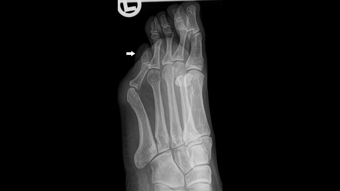 Röntgenaufnahme des linken Vorfußes: Befund eines Digitus quintus varus superductus