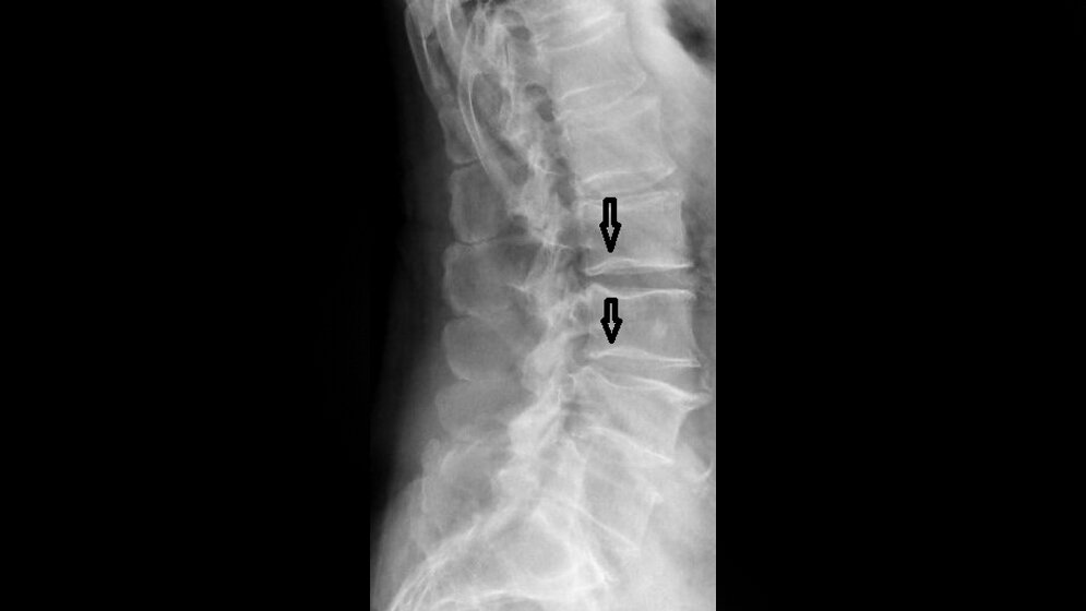 Anomalien und Normvarianten – Skelettale Veränderungen 3.17