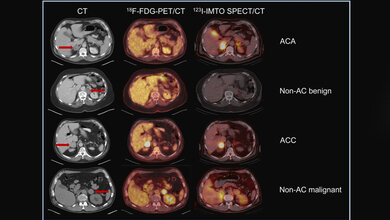 neue_Tracer.jpg Beispiele für die Kategorisierung in die vier Tumorsubgruppen basierend auf den Ergebnissen der Bildgebung mittels FDG-PET und IMTO-SPECT.