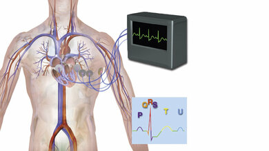 EKG bei Lungenarterienembolie