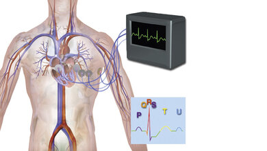 Das pathologische EKG EKG bei Lungenarterienembolie