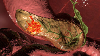 Pankreaskarzinom besser diagnostizieren