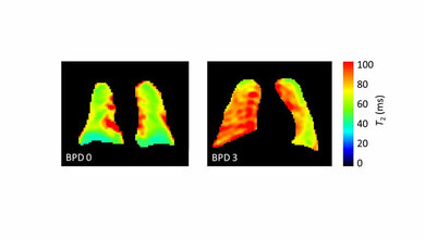 erhöhte T2-Relaxationszeiten