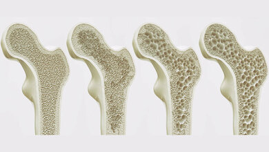 Stufen der Osteoporose