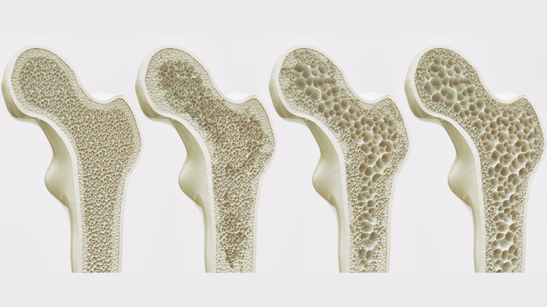 Stufen der Osteoporose
