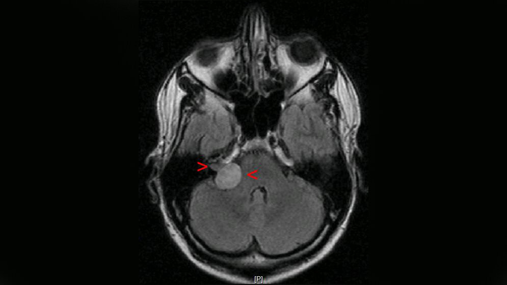 Akustikusneurinom rechts