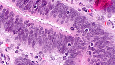 Dickdarmkrebs mit Lymphozyten im Tumor, HNPCC